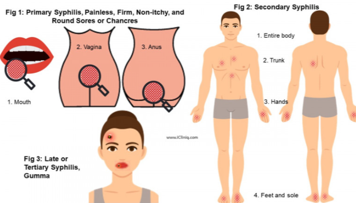Penyakit Sifilis Sering Menjadi Perbincangan, Apa Penyebabnya?