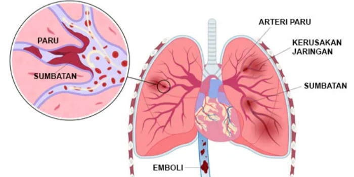 Emboli Dan Trombus Berbeda, Apa Dampaknya Bagi Tubuh?