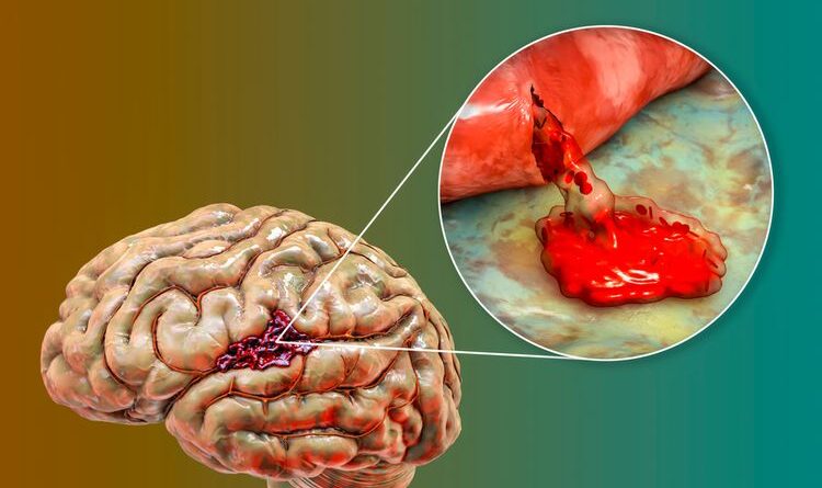 Pendarahan Otak Di Sebabkan Oleh Apa? Ketahui Yuk!