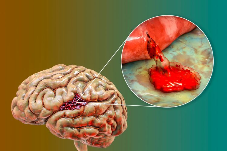 Pendarahan Otak Di Sebabkan Oleh Apa? Ketahui Yuk!