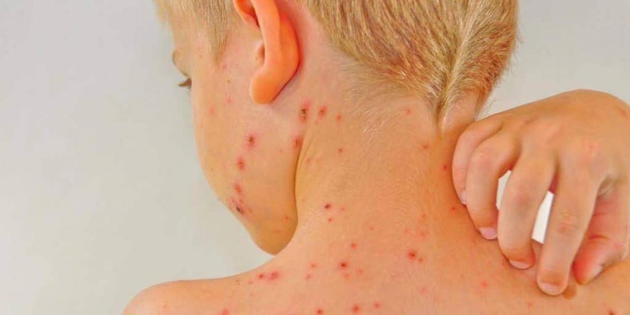 Paparan Campak Di Temukan Di Tempat Umum Carolina Selatan