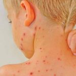 Paparan Campak Di Temukan Di Tempat Umum Carolina Selatan