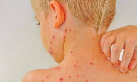 Paparan Campak Di Temukan Di Tempat Umum Carolina Selatan