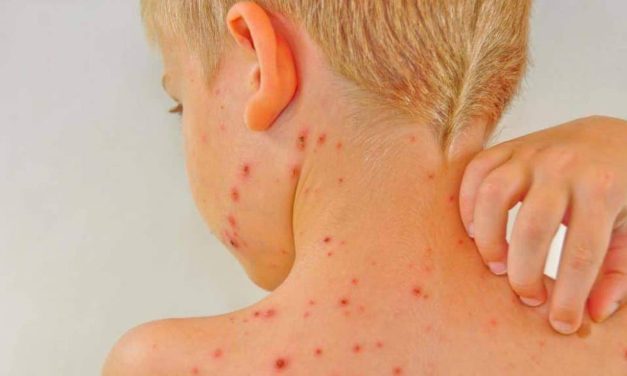 Paparan Campak Di Temukan Di Tempat Umum Carolina Selatan