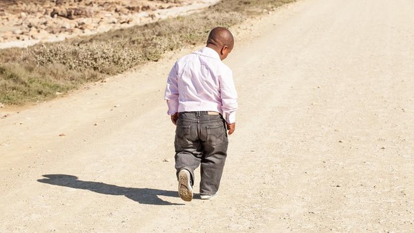 Achondroplasia, Kelainan Genetik Penyebab Tubuh Pendek