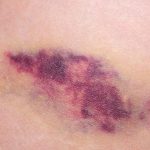 Angiosarkoma, Kanker Langka Agresif Dan Perlu Kewaspadaan