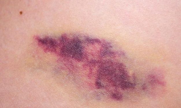 Angiosarkoma, Kanker Langka Agresif Dan Perlu Kewaspadaan