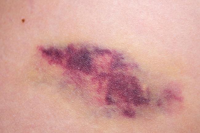 Angiosarkoma, Kanker Langka Agresif Dan Perlu Kewaspadaan