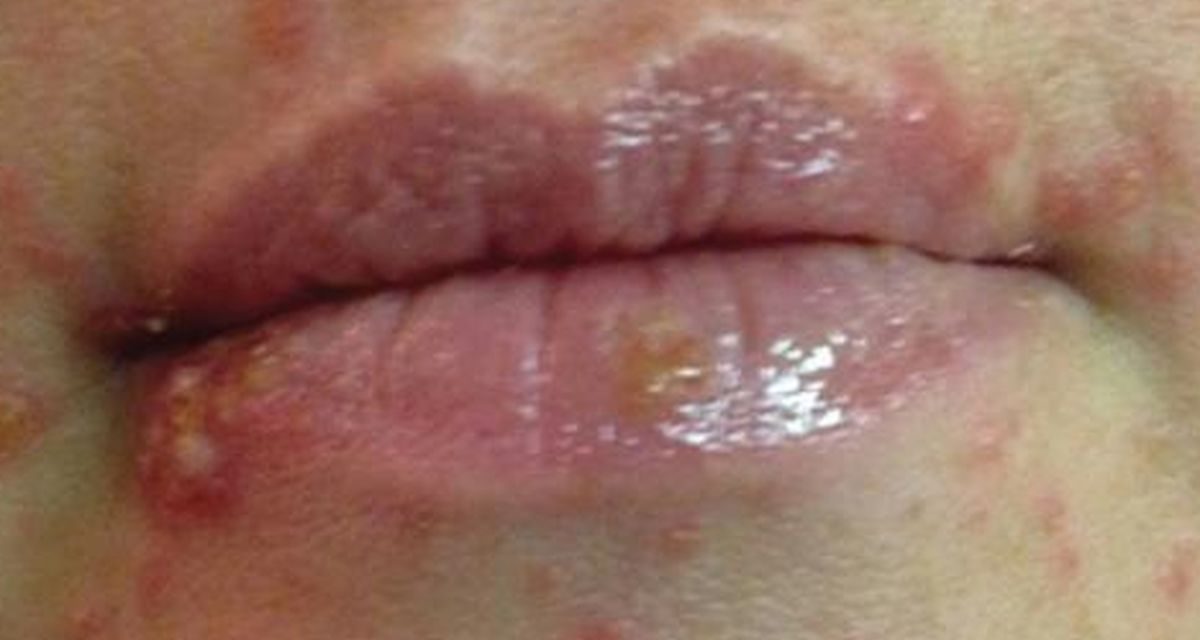 Penyakit Sifilis Infeksi Menular Seksual Yang Berbahaya