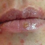 Penyakit Sifilis Infeksi Menular Seksual Yang Berbahaya