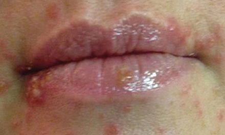 Penyakit Sifilis Infeksi Menular Seksual Yang Berbahaya