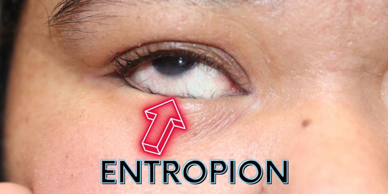 Entropion, Gangguan Kelopak Mata yang Dapat Mengiritasi Mata