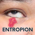 Entropion, Gangguan Kelopak Mata yang Dapat Mengiritasi Mata
