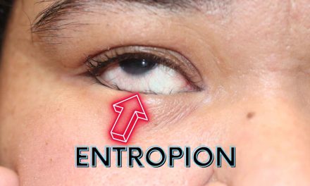 Entropion, Gangguan Kelopak Mata yang Dapat Mengiritasi Mata