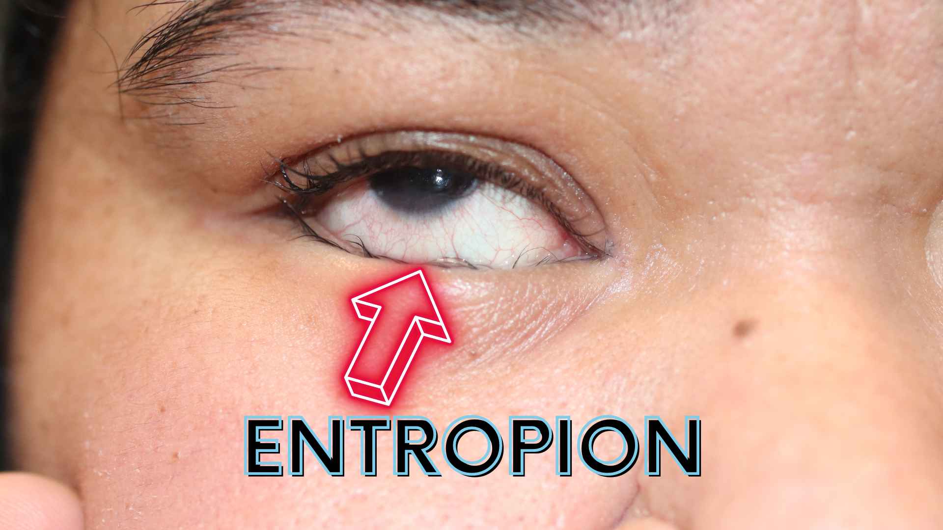 Entropion