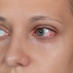 Uveitis, Peradangan Mata yang Perlu Di Waspadai