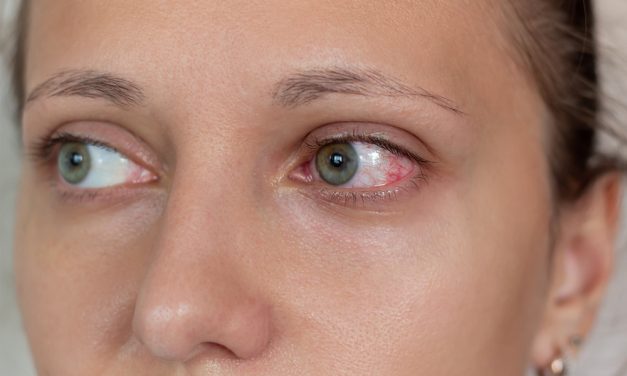 Uveitis, Peradangan Mata yang Perlu Di Waspadai