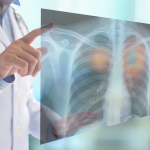 Tumor Askin, Kanker Langka pada Dinding Dada Perlu Diwaspadai