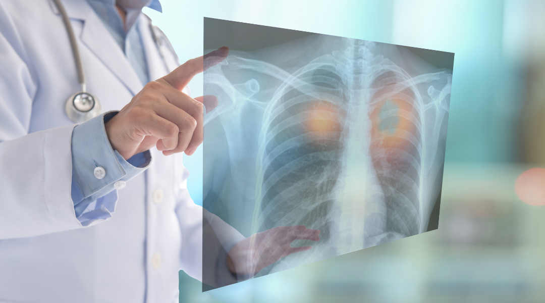 Tumor Askin, Kanker Langka pada Dinding Dada Perlu Diwaspadai