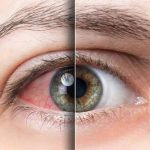 Fotokeratitis, Terbakar Kena Sinar UV Berlebih, Ini Pengobatannya