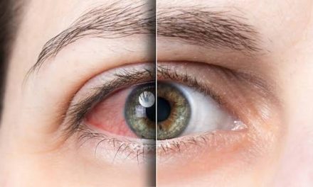 Fotokeratitis, Terbakar Kena Sinar UV Berlebih, Ini Pengobatannya