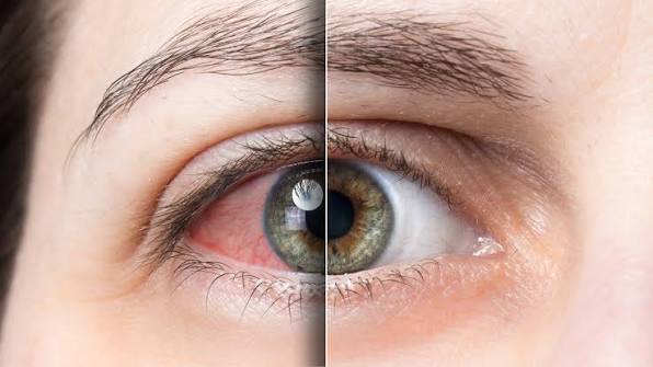 Fotokeratitis, Terbakar Kena Sinar UV Berlebih, Ini Pengobatannya